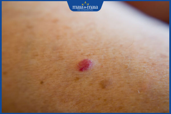 nhận biết chấm đỏ trên da