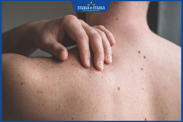 Da nổi đốm nâu ngứa là bị làm sao? Địa chỉ điều trị uy tín 2 nhận biết da nổi đốm nâu ngứa
