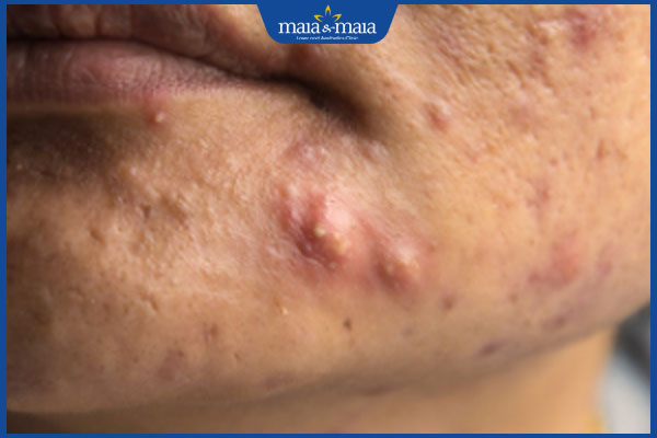 nhận biết mụn nang