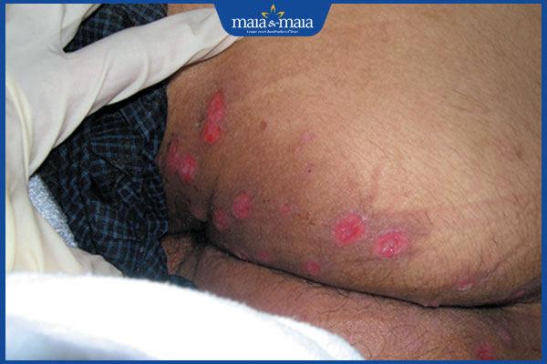 Mụn rộp sinh dục ở hậu môn do đâu? Điều trị như thế nào? 2 nhận biết mụn rộp ở hậu môn