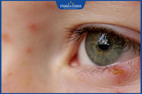 Mụn rộp ở mắt: Nguyên nhân, cách điều trị và phòng ngừa 2 nhận biết mụn rộp quanh mắt