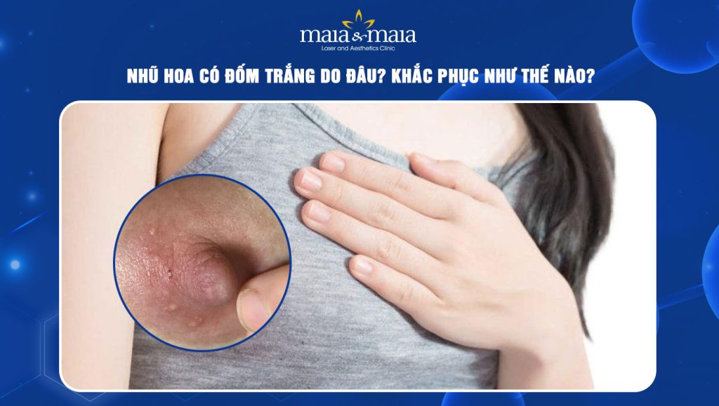 Nhũ hoa có đốm trắng do đâu? Khắc phục như thế nào? 1 Nhũ hoa có đốm trắng