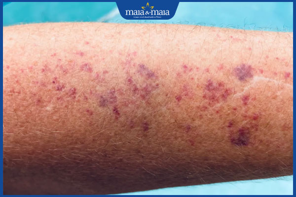 Làn da nổi đốm đỏ hình thành do đâu? Điều trị như thế nào? 2 nổi đốm đỏ trên tay