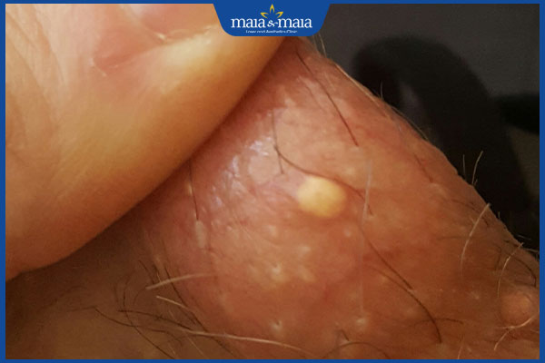 nổi đốm trắng ở bìu