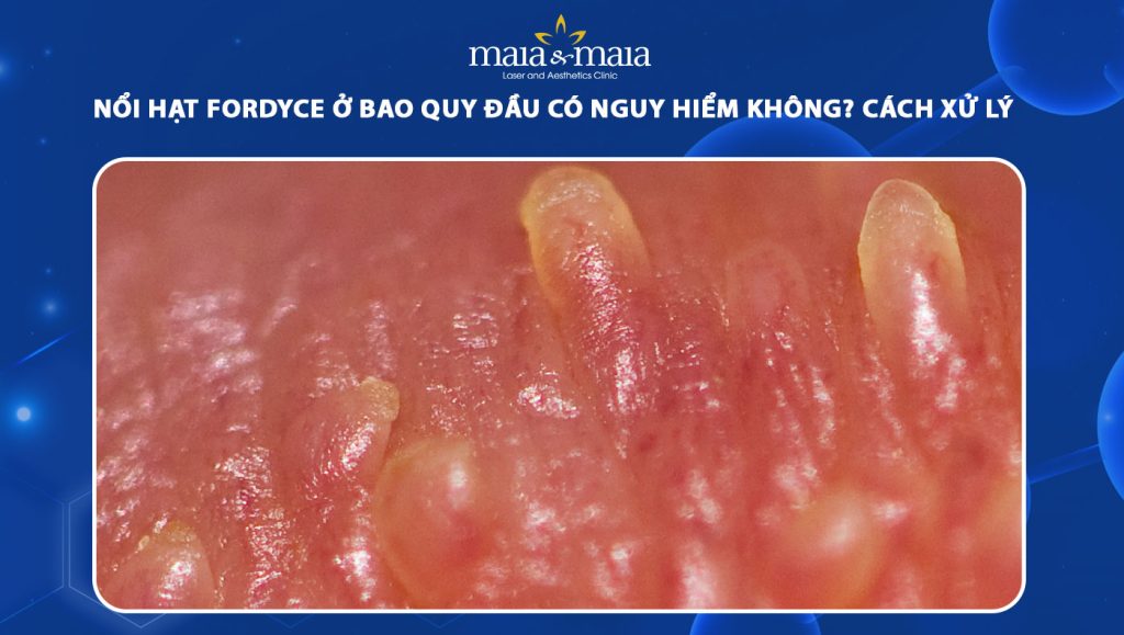 nổi hạt fordyce o bao quy dau