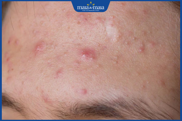 nổi mụn do dị ứng