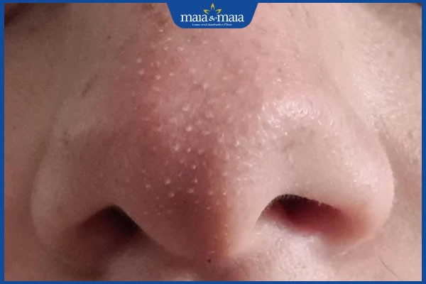 Mụn gạo ở mũi là gì? Cách điều trị mụn gạo trên mũi dứt điểm 2 nổi mụn gạo ở mũi