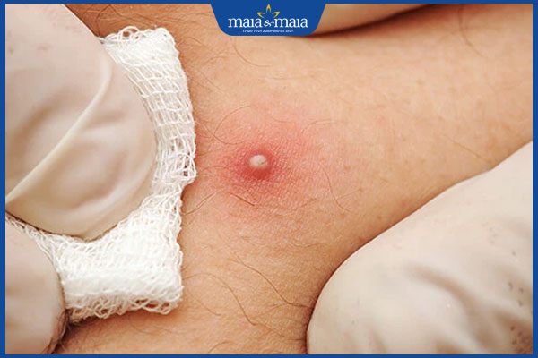 Mụn ở bụng do đâu? Làm sao để loại bỏ mụn hiệu quả? 2 nổi mụn ở bụng