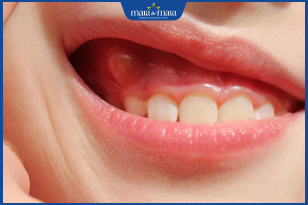 nổi mụn ở lợi