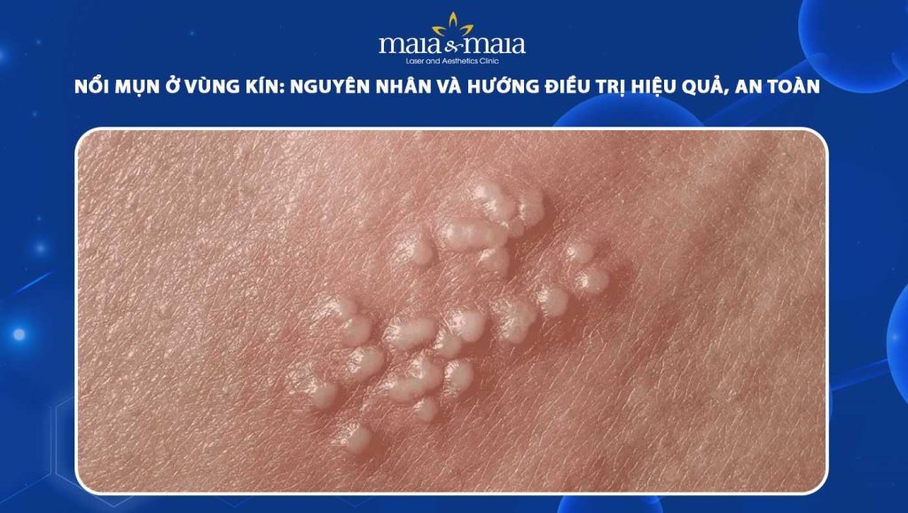 nổi mụn ở vùng kín