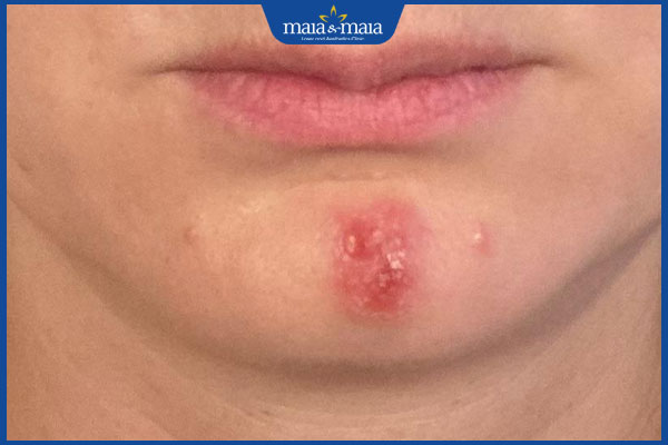 Mụn rộp ở cằm xuất hiện do đâu? Cách điều trị và phòng ngừa 2 nổi mụn rộp ở cằm