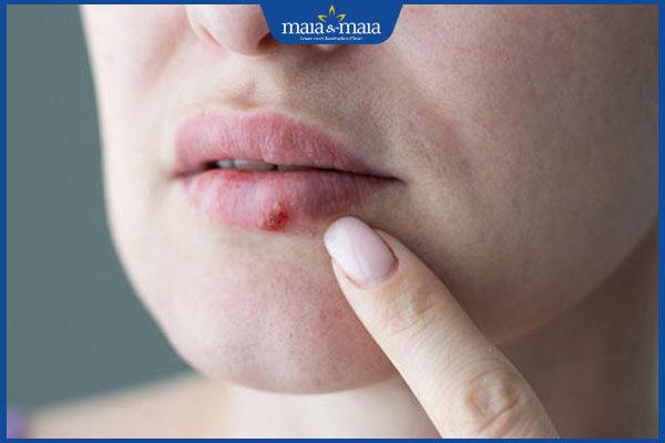 nổi mụn rộp ở môi