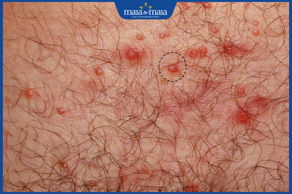 Mụn rộp sinh dục nam có nguy hiểm không? Điều trị ở đâu tốt? 5 nổi mụn rộp sinh dục ở nam giới