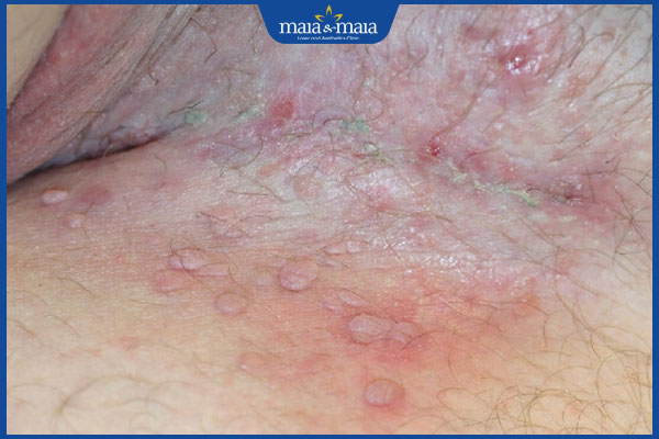 nổi mụn thịt ở háng