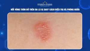 nổi vòng tròn đỏ trên da