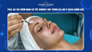 Peel da trị thâm mụn