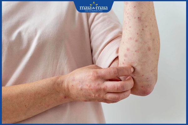 Nổi vòng tròn đỏ trên da là bị sao? Điều trị và phòng ngừa 2 phát ban