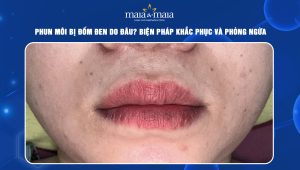 phun môi bị đốm đen