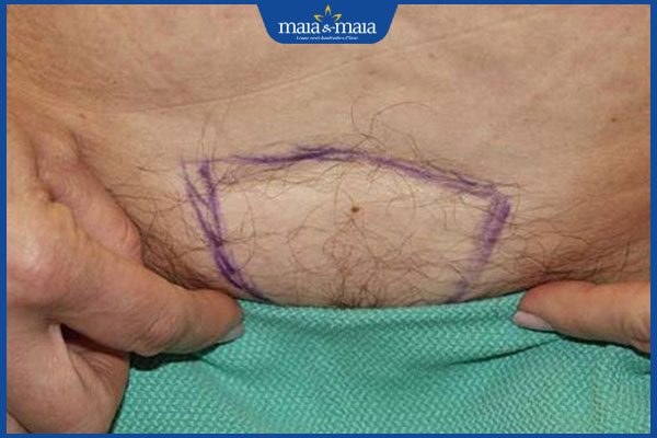 Cấy lông mu là gì? Quy trình, lợi ích và lưu ý quan trọng 4 quy trình cấy lông mu