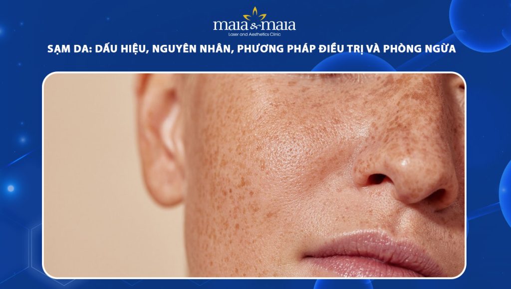 Sạm da: Dấu hiệu, nguyên nhân, cách điều trị và phòng ngừa 1 sạm da