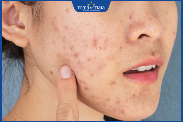 thâm mụn ở má