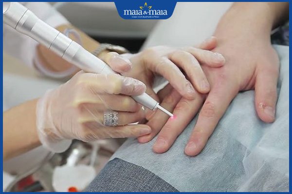 tiến hành đốt mụn thịt