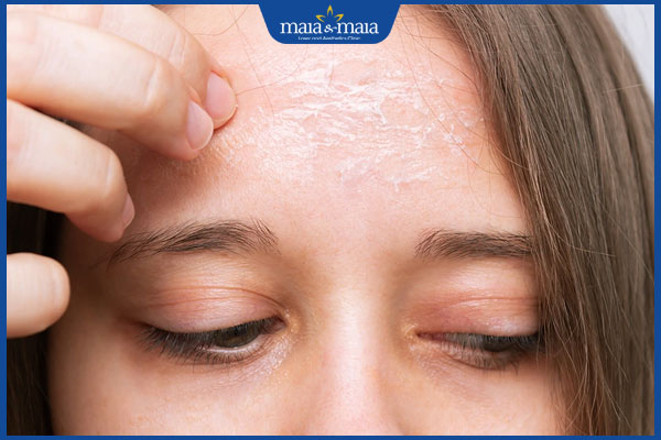 tình trạng da sau lột mụn