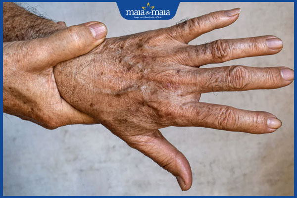 tình trạng da tay bị sạm