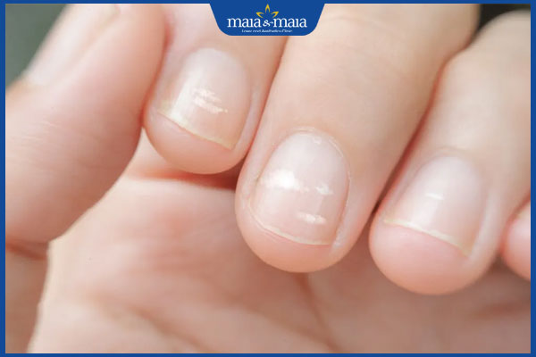 Móng tay có đốm trắng ở trẻ: Nguyên nhân và cách phòng ngừa 2 tình trạng móng tay trẻ có đốm trắng