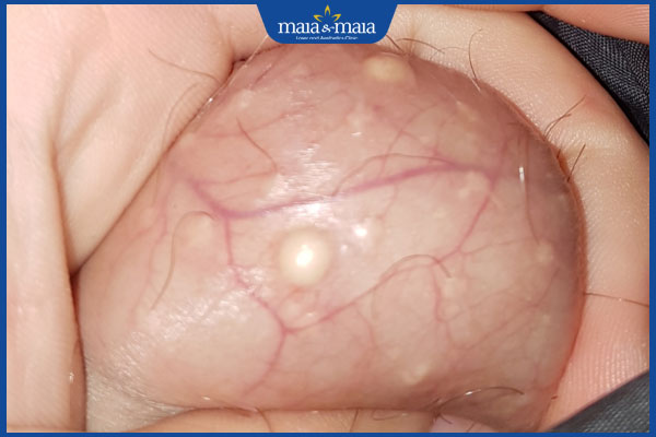 Nổi mụn ở tinh hoàn có nguy hiểm không? Chuyên gia tư vấn 2 tình trạng nổi mụn ở tinh hoàn