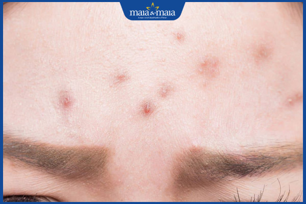 Mụn nội tiết ở trán do đâu? Làm sao để điều trị hiệu quả? 2 trán nổi mụn nội tiết