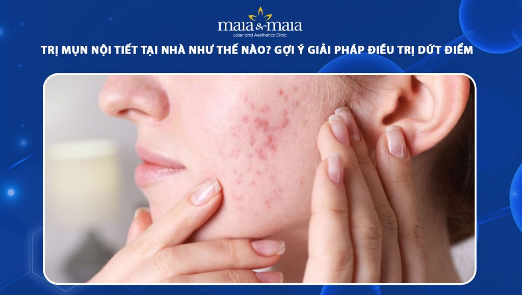 Tổng hợp các cách trị mụn nội tiết an toàn, hiệu quả tại nhà 1 trị mụn nội tiết