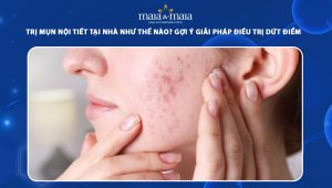 trị mụn nội tiết