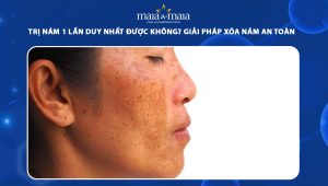 trị nám 1 lần duy nhất được không