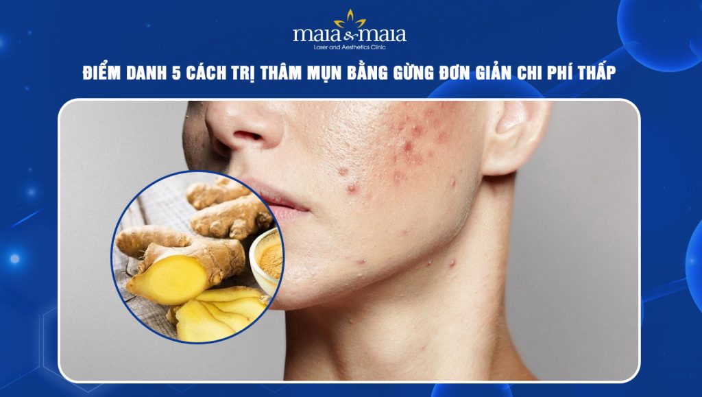 trị thâm mụn bằng gừng