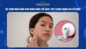 trị thâm mụn bằng kem đánh răng