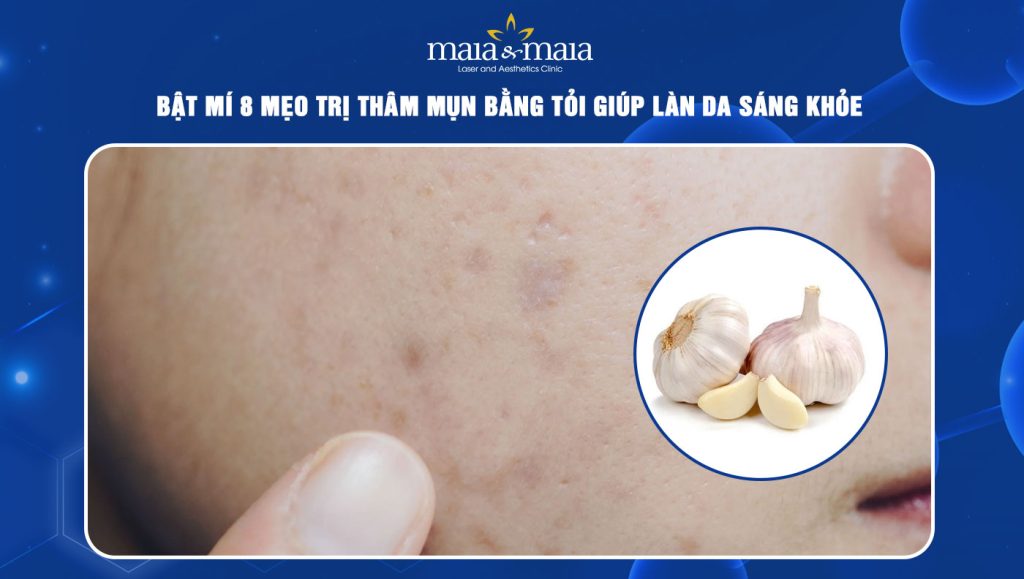 Trị thâm mụn bằng tỏi