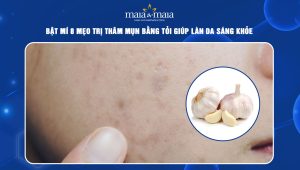 Trị thâm mụn bằng tỏi