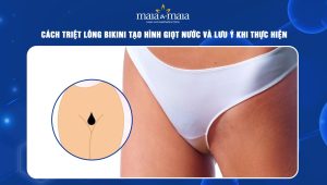 triệt lông bikini tạo hình giọt nước
