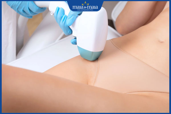 triệt lông vùng kín bằng laser