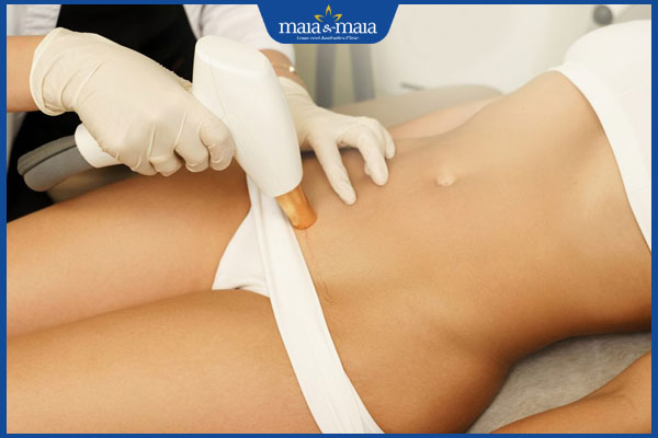 Triệt lông bikini tạo hình: Lợi ích và địa chỉ thực hiện 2 triệt lông vùng kín tạo hình