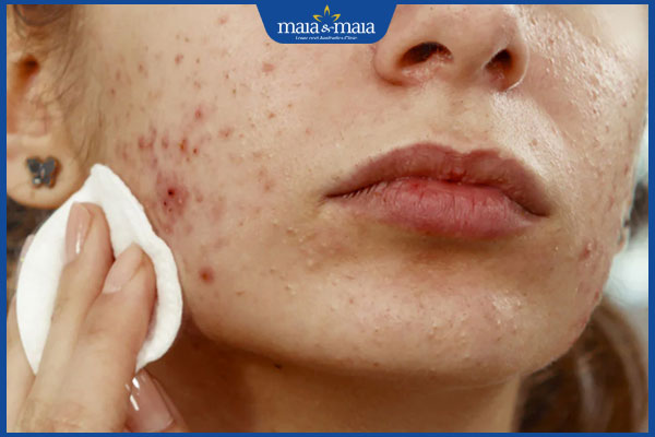 Những sai lầm khi chăm sóc da mụn nhiều người đang mắc phải 2 vệ sinh sạch sẽ cho da mụn nội tiết