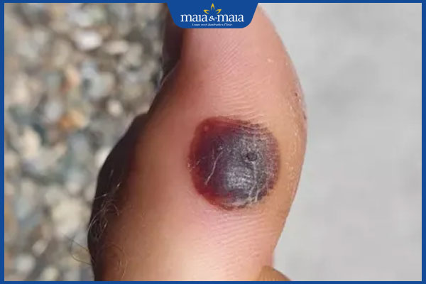 vùng da sau đốt mụn thịt bị thâm sạm