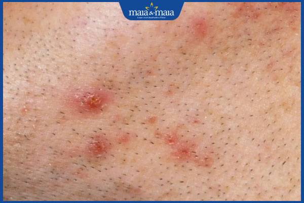 Kem tẩy lông vùng kín có hại không? Cần lưu ý gì khi sử dụng 2 vùng kín mẩn đỏ sau khi tẩy lông