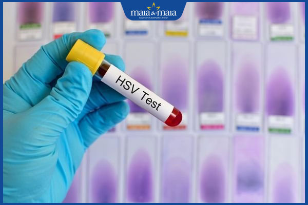 Nguyên nhân nổi đốm trắng trên môi và cách điều trị hiệu quả 3 xét nghiệm hsv