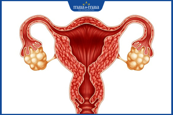 buồng trứng đa nang