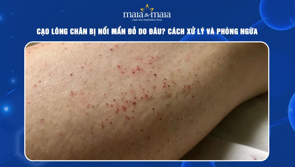 cạo lông chân bị nổi mẩn đỏ
