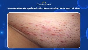 cạo lông vùng kín bị mẩn đỏ