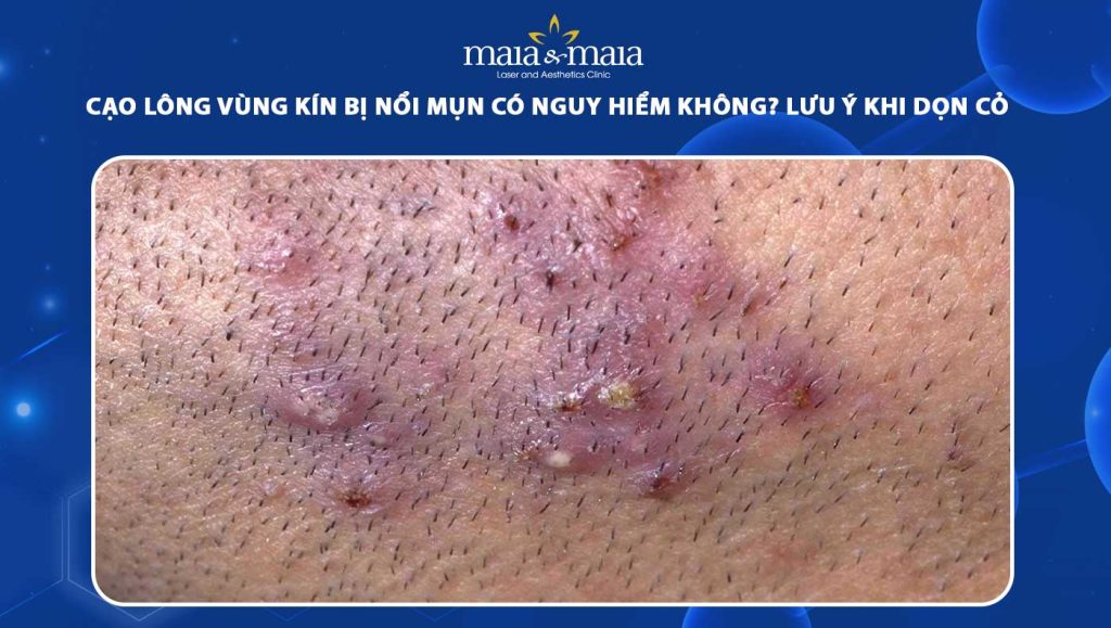 cạo lông vùng kín bị nổi mụn