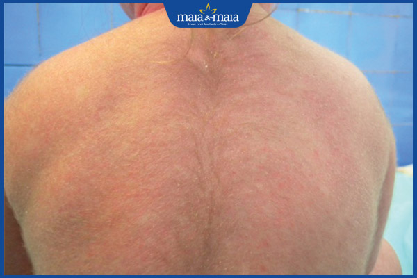 chứng rậm lông ở trẻ